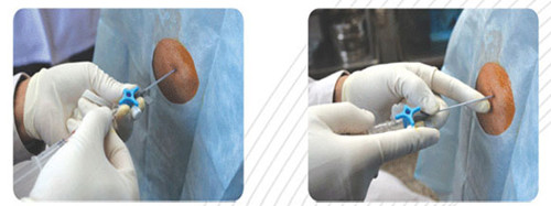 结核性胸膜炎胸痛中医治疗,胸痛12种图解