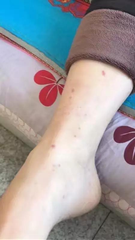 过敏性紫癜的危害有哪些,过敏性紫癜喝冷饮的危害