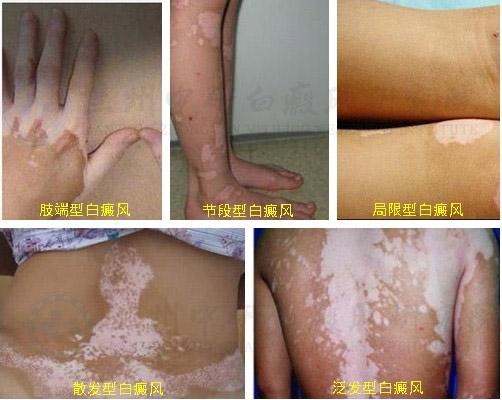 微科普——白癜风疾病的诊断标准
