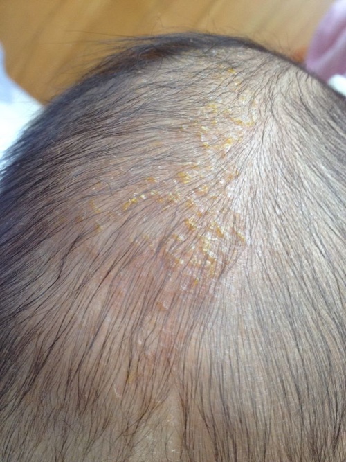 脂溢性湿疹结的黄痂能洗掉吗,湿疹起黄痂是快好了还是严重了