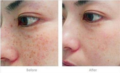 药水祛雀斑好还是激光祛雀斑好,激光祛雀斑最有效的方法
