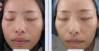 药水祛雀斑好还是激光祛雀斑好,激光祛雀斑最有效的方法