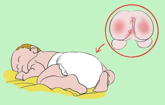 天天兜尿不湿宝宝红屁股了，该怎么办？