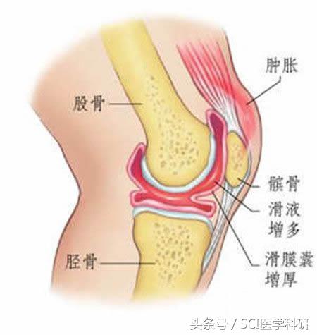 膝盖活动的时候有脆响,活动时膝关节发出响声是怎么回事