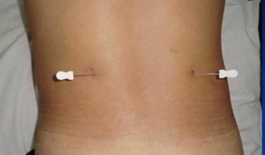 腰椎间盘突出345节怎样治疗才能好,腰椎间盘4-5节突出症恢复锻炼方法