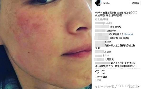 舒淇过敏化妆视频教程,舒淇皮肤敏感恢复