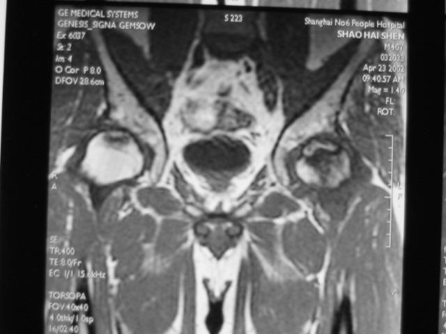 早期股骨头坏死核磁共振能看到吗,股骨头坏死修复过程的磁共振表现