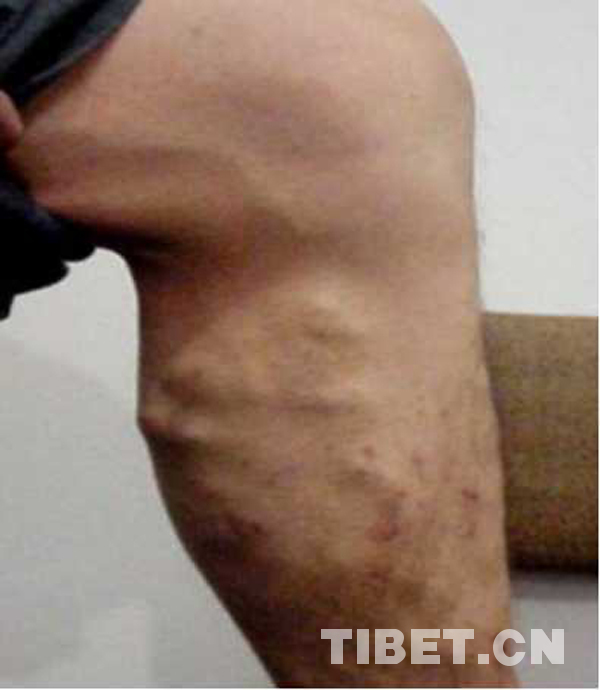 援藏医疗活动,组团式援藏