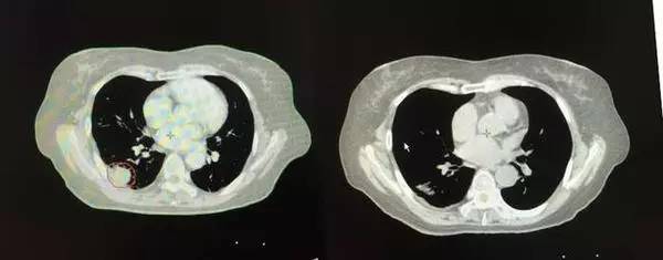 a45治疗癌症有效吗,a45治疗费用