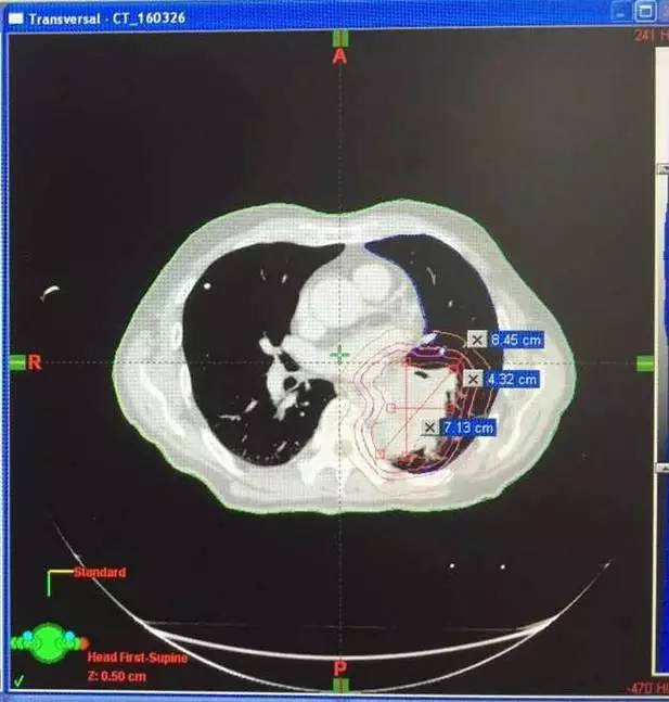 a45治疗癌症有效吗,a45治疗费用
