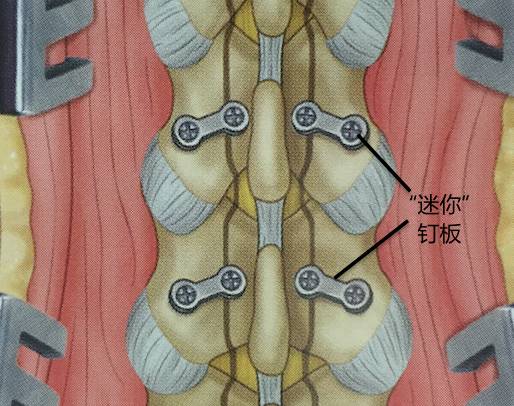 腰腿疼是椎管肿瘤吗,腰腿疼痛需要注意脊髓肿瘤吗