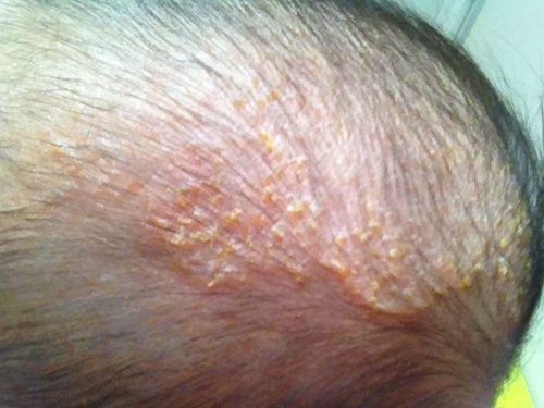 脂溢性湿疹结的黄痂能洗掉吗,湿疹起黄痂是快好了还是严重了