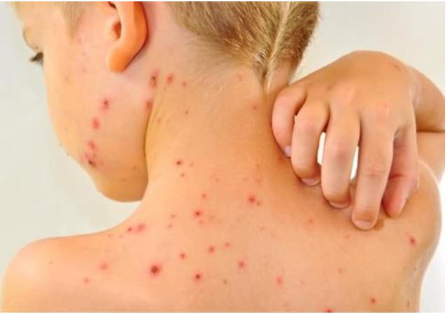 幼儿水痘家长怎么预防,水痘进入高发期谨防水痘侵袭