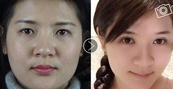 全切双眼皮增生不对称变丑,割完双眼皮为啥会变内双