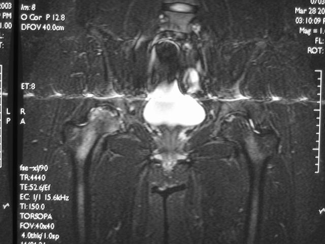 早期股骨头坏死核磁共振能看到吗,股骨头坏死修复过程的磁共振表现