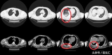 胸痛可能是肺的原因吗,胸痛咯血