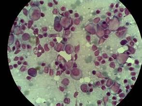 泌尿系统肿瘤研究进展,泌尿系统癌好治疗吗