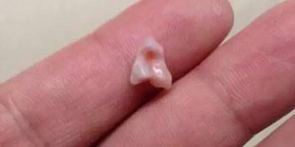 小孩牙齿一块块掉怎么回事,两岁孩子牙齿一块块掉是怎么了