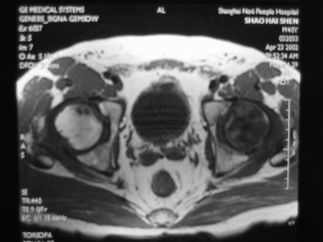早期股骨头坏死核磁共振能看到吗,股骨头坏死修复过程的磁共振表现