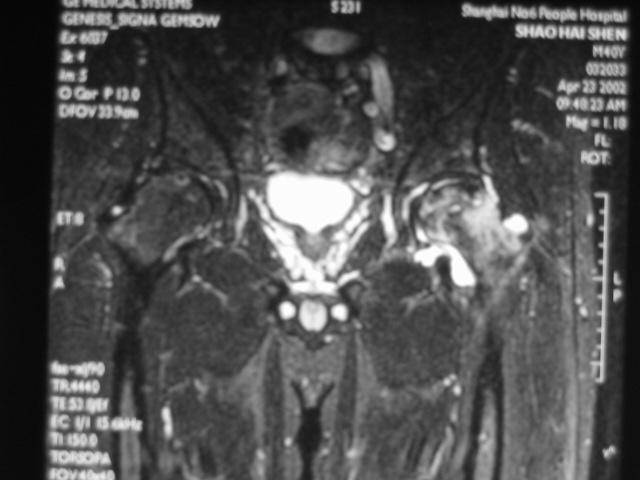 早期股骨头坏死核磁共振能看到吗,股骨头坏死修复过程的磁共振表现
