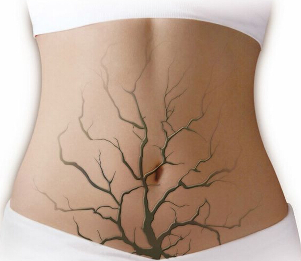 慢性肾炎怎么帮助肾排毒,肾炎到尿毒症患者