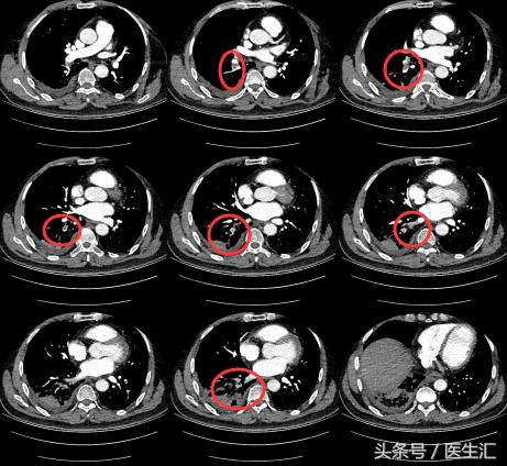 胸痛可能是肺的原因吗,胸痛咯血