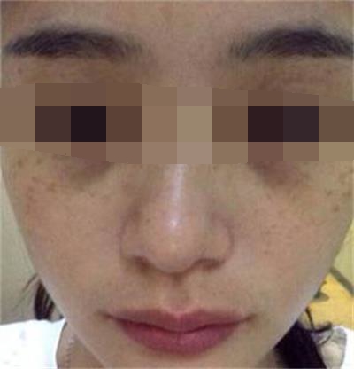 色素沉着该如何解决,色素沉着最佳解决方法