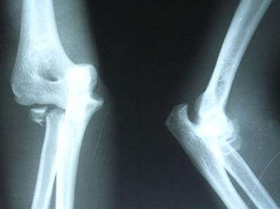 骨髓炎和脊柱炎一样吗,骨髓炎与骨不连的关系