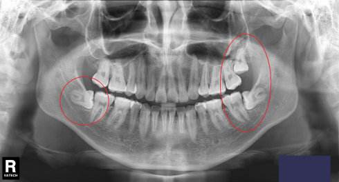 智齿横着长没露出来,智齿牙横着长怎么办
