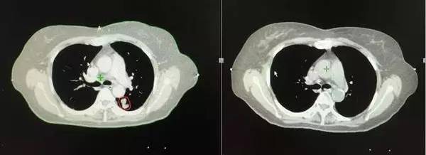 a45治疗癌症有效吗,a45治疗费用
