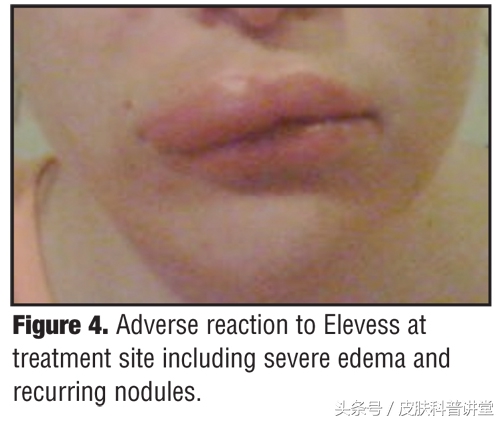 玻尿酸透明质酸危害,透明质酸注射液功效