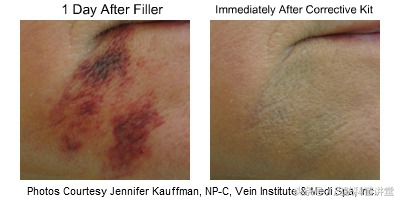 玻尿酸透明质酸危害,透明质酸注射液功效