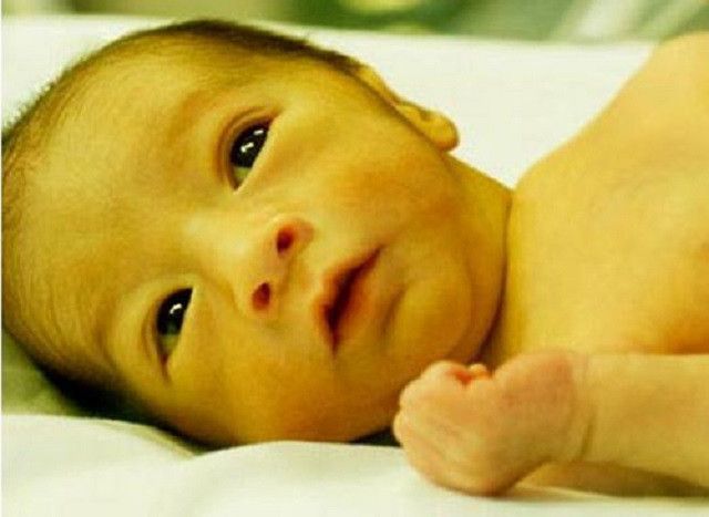 宝宝黄疸没去照蓝光的后果,宝宝黄疸不治的后果