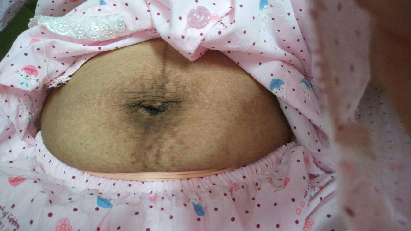 生完宝宝肚子还那么大?真正的原因在这里!