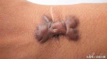 丑陋的疤痕布满整张脸,旧疤痕怎么去除最有效