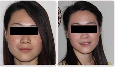 雀斑真的能激光祛除吗,光子祛斑和激光祛斑