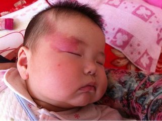 认识胎记,科普为什么很多婴儿有胎记