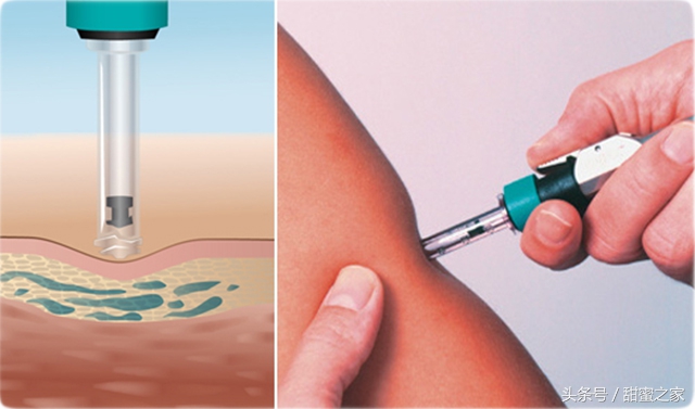 世界最前沿治糖尿病科技,世界最新糖尿病医学突破
