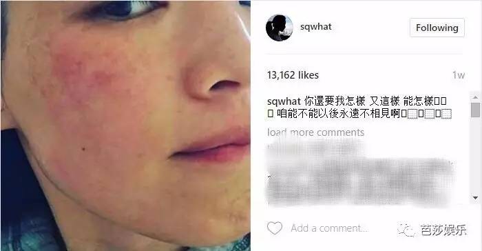 舒淇过敏发作视频,舒淇过敏