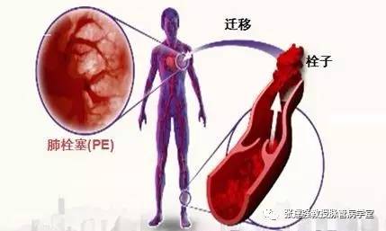 产后不下床，血栓把命夺