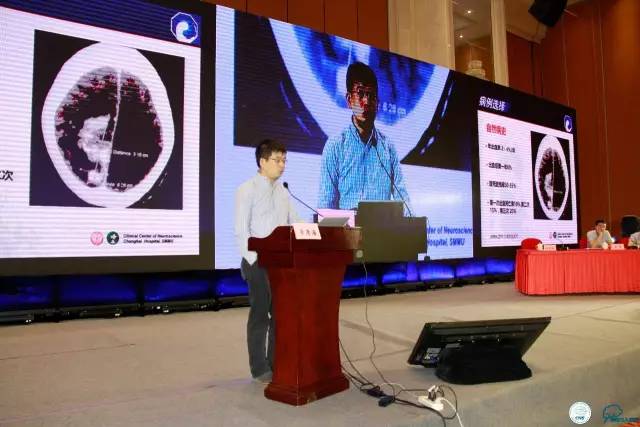 脑动静脉栓塞介入全过程,脑动静脉畸形介入一般栓塞几次