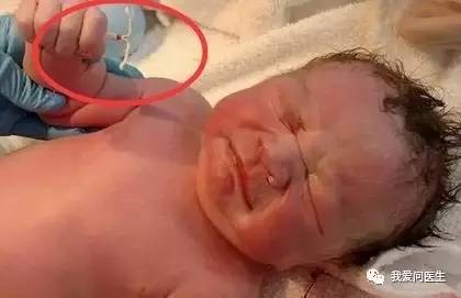 「扩散」陈素文：取环不是选择题！