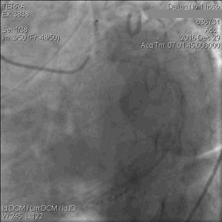 急性心肌梗死心源性休克时的处理,急性心肌梗死心源性休克最常见