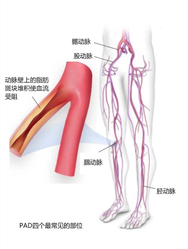 走路屁股老是抽筋,走路右屁股突然抽筋