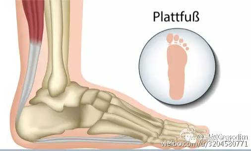 一只脚扁平足怎么矫正,瑜伽扁平足的矫正方法