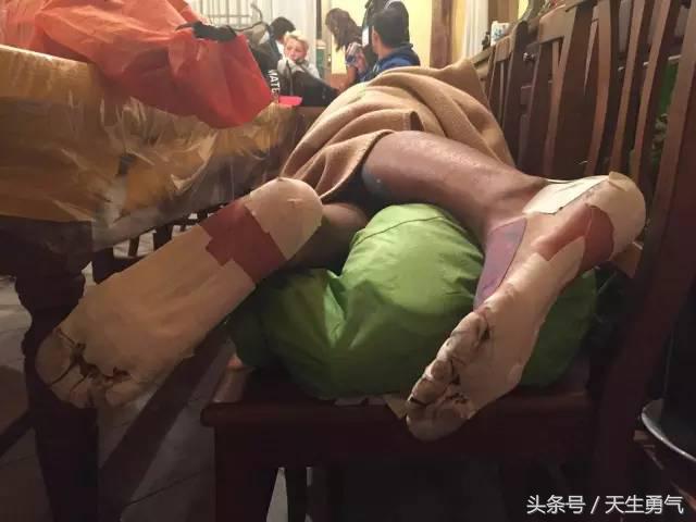 520公里血泪史，要了命的脚底泡