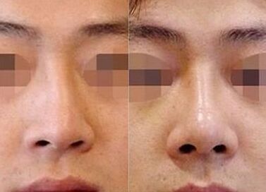 歪鼻子去哪里矫正,歪鼻子应该怎么办呢