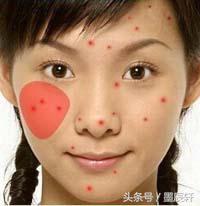 关于痘痘肌肤应该如何护肤,关于痘痘治疗方法