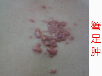 痘痘引起肿胀,痘痘引起的肿块是什么