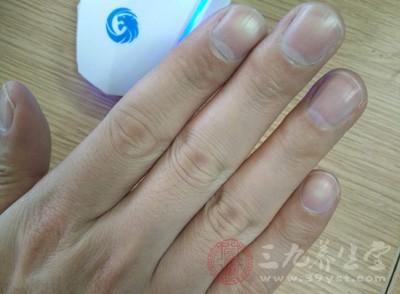 指甲上面有小白点怎么回事,指甲里的小白点是怎么回事